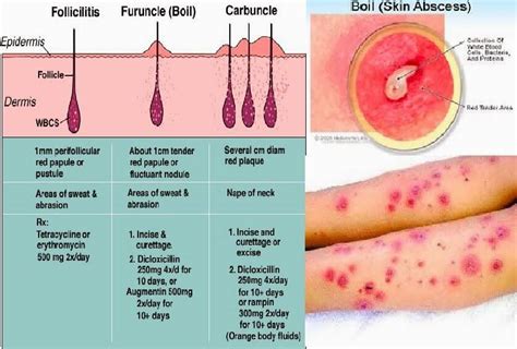 Furuncle: Causes, Symptoms, and Treatments .